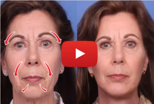 how to get rid of forehead wrinkles how to get rid of smile lines how to reduce wrinkles