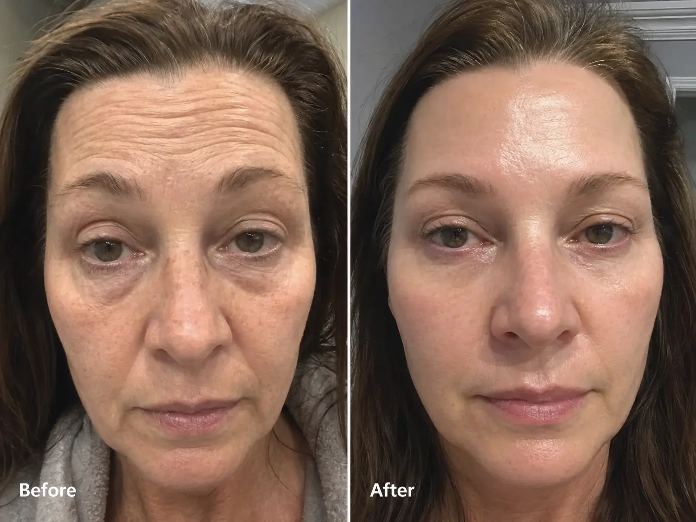 Forehead Wrinkle Treatment